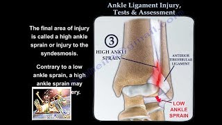 Ankle Ligament Injury evaluation and tests  Everything You Need To Know  Dr Nabil Ebraheim [upl. by Livvy]