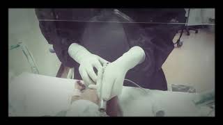 Neonatal intubation  ETT NICU [upl. by Lindo]