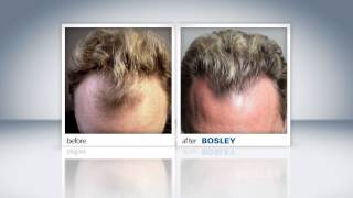 Bosley Hair Restoration Patient Review  Bill S [upl. by Lytsirk736]