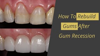 Gum Recession Cure  How to Rebuild Gums [upl. by Kelci]