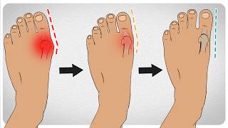 How to Fix Bunions in 5 Steps [upl. by Devy116]