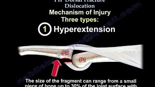 PIP Dorsal Fracture Dislocation  Everything You Need To Know  Dr Nabil Ebraheim [upl. by Balmuth748]