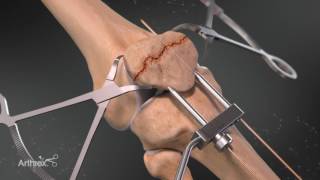 The Arthrex Patella Fracture System [upl. by Adlig]