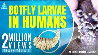 botfly larvae in humans [upl. by Anitsej34]