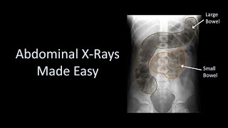 Abdominal XRays Made Easy [upl. by Colier242]