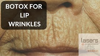 BOTOX for lip wrinkles [upl. by Milicent]