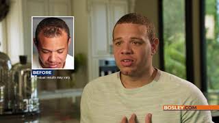 Bosley Hair Transplant Review  Troy P [upl. by Yrakcaz]