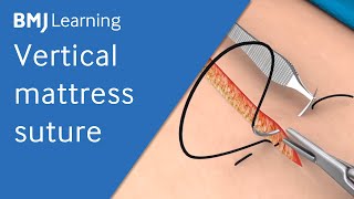 Vertical Mattress Suture  BMJ Learning [upl. by Illoh]