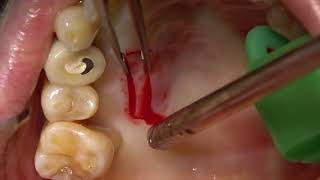 Mixed EpithelialConnective tissue graft harvesting from palate [upl. by Ahseik310]