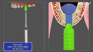 CAS KIT Crestal Approach  Sinus KIT [upl. by Annagroeg975]