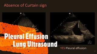 Pleural Effusion Lung Ultrasound Perioperative amp Critical Care POCUS [upl. by Ema]