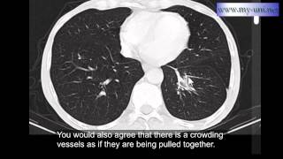 Rounded atelectasis  CT scan of Chest [upl. by Mercuri]