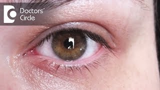 How to treat eye redness amp pain  Dr Sriram Ramalingam [upl. by Agna]