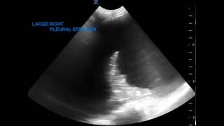 Pleural Effusion on Ultrasound JETem 2016 [upl. by Abisha]