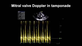 Echocardiography Essentials Detecting pericardial effusions [upl. by Yatnuahc852]