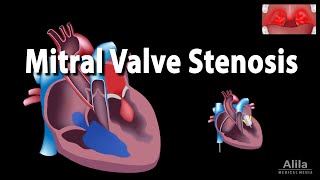 Mitral Valve Stenosis Animation [upl. by Kingdon]