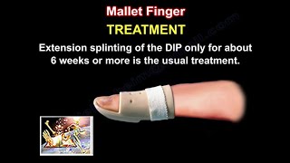 Mallet Finger Treatment  Everything You Need To Know  Dr Nabil Ebraheim [upl. by Inajar711]