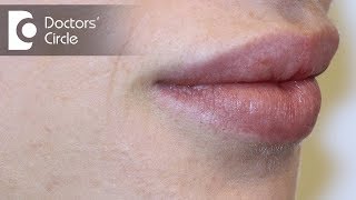 Causes of white spots on lipsDr Nischal K [upl. by Valencia997]