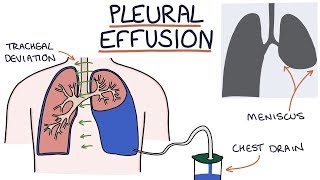 Understanding Pleural Effusions [upl. by Malchy]