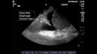 Lung and Pleural Ultrasound Interpretation [upl. by Oiramel]