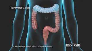 Colon Care Diverticulosis and Diverticulitis [upl. by Narcho]