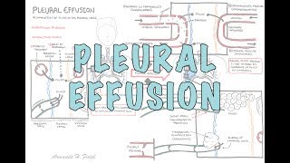 Pleural Effusion DETAILED  pathophysiology signs and symptoms treatment [upl. by Doowrehs501]