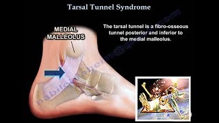 Tarsal Tunnel Syndrome  Everything You Need To Know  Dr Nabil Ebraheim [upl. by Esila59]