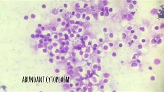 Transitional epithelial cells in urine [upl. by Crescantia]