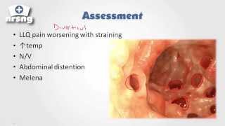 Diverticulitis Signs amp Symptoms And Why They Occur [upl. by Pass]