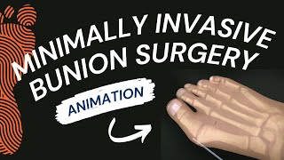 Minimally Invasive Bunion Surgery A Short Animation [upl. by Anaeg]