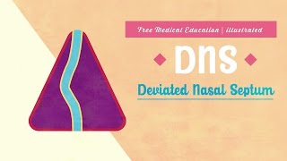 What is Deviated Nasal Septum DNS [upl. by Argent]