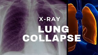 Xray in Lung Collapse [upl. by Adiaroz]