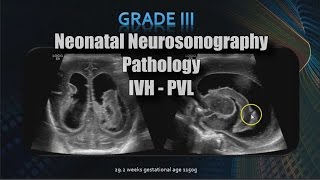 Neonatal Neurosonography  Pathology  IVH  PVL [upl. by Ahcropal]