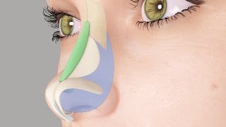 Saddle Nose or Ski Slope Nose Rhinoplasty Nosejob [upl. by Baer]