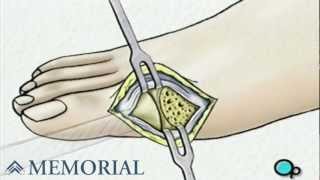 Bunion Removal Foot Surgery [upl. by Nara]