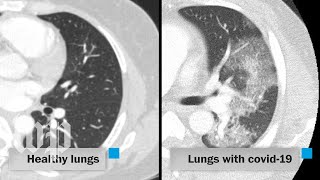 How covid19 attacks the lungs [upl. by Atiuqin]