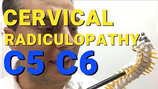 What Is C5 C6 Radiculopathy What Causes Cervical Radiculopathy Dr Walter Salubro [upl. by Nosinned]