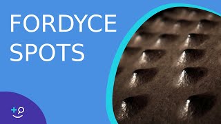 Fordyce Spots Oil Glands or Warts [upl. by Os]