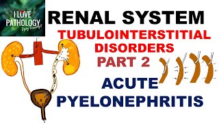 ACUTE PYELONEPHRITIS Pathology [upl. by Schinica]