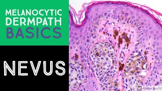 Atypical Moles What Are They Dermatology 2019 [upl. by Ylsel]