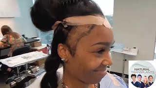 Best Female Hair Transplant Before and After  Hair Loss amp Traction Alopecia in Women Tanya [upl. by Aliuqehs]