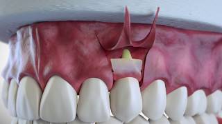 Subepithelial Connective Tissue Grafting [upl. by Chimene62]