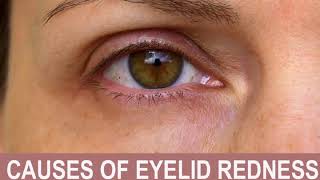 Causes of Eyelid Redness [upl. by Naitsirhk897]