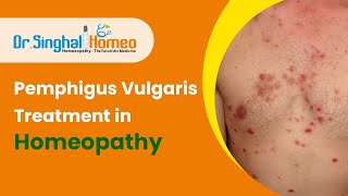 Best Homeopathic Treatment for Pemphigus Vulgaris  Dr Singhal Homeo [upl. by Arette]