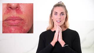 How To Treat Skin Redness  Rosacea  its Causes and Treatments [upl. by Shatzer]