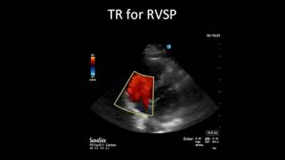 Principles of Doppler Ultrasound [upl. by Kotto139]