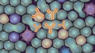 Treating Follicular Lymphoma [upl. by Suisyola548]