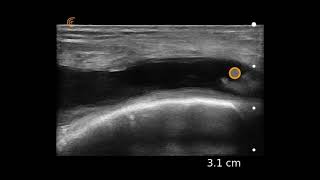 Knee Effusion Ultrasound Image Interpretation [upl. by Nilyac710]