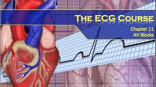 The ECG Course  AV Blocks [upl. by Egdirdle334]