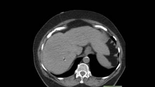 CT Abdomen Epiploic Appendagitis and anatomy [upl. by Artimas858]